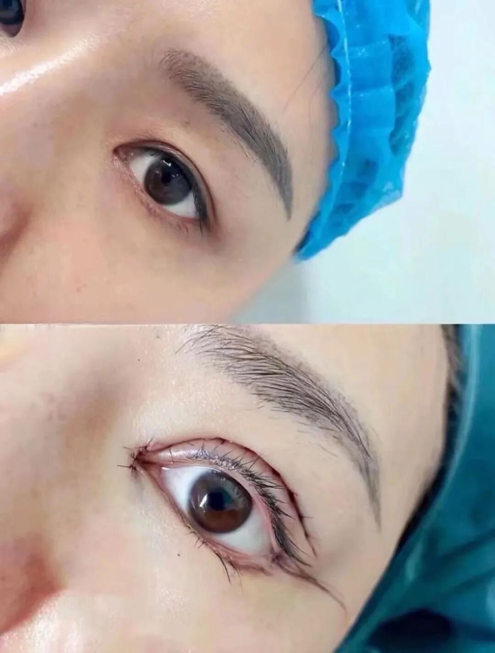 双眼皮手术要多少钱？双眼皮手术痛不痛？