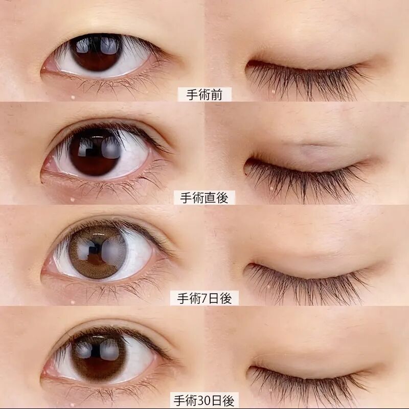 日式无痕双眼皮是埋线吗？日式无痕双眼皮效果好吗？