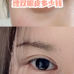 杭州埋线双眼皮价格多少钱？杭州专业美容医院埋线双眼皮手术费用详情