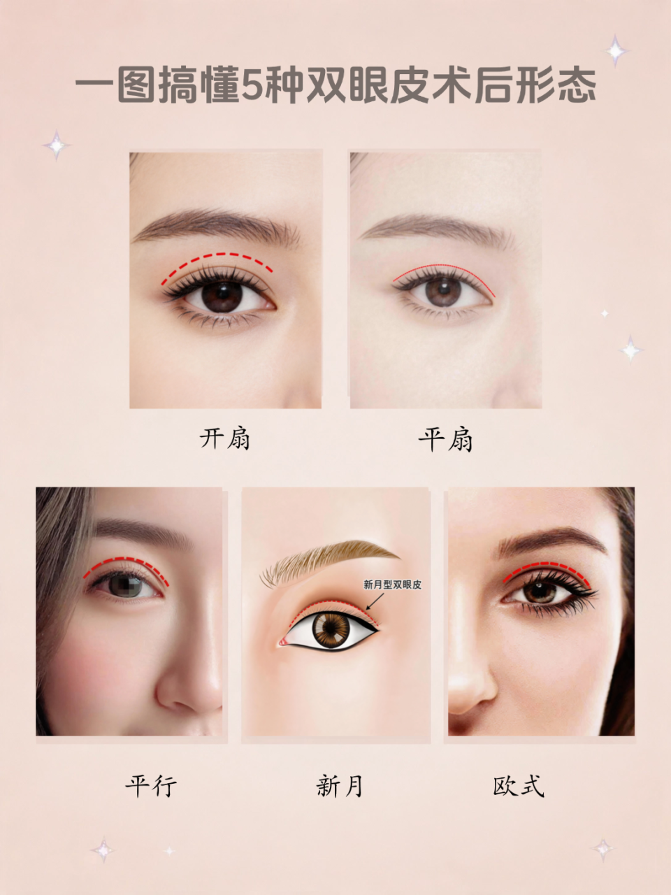 单眼皮如何变双眼皮?手术做双眼皮的过程是怎样的?