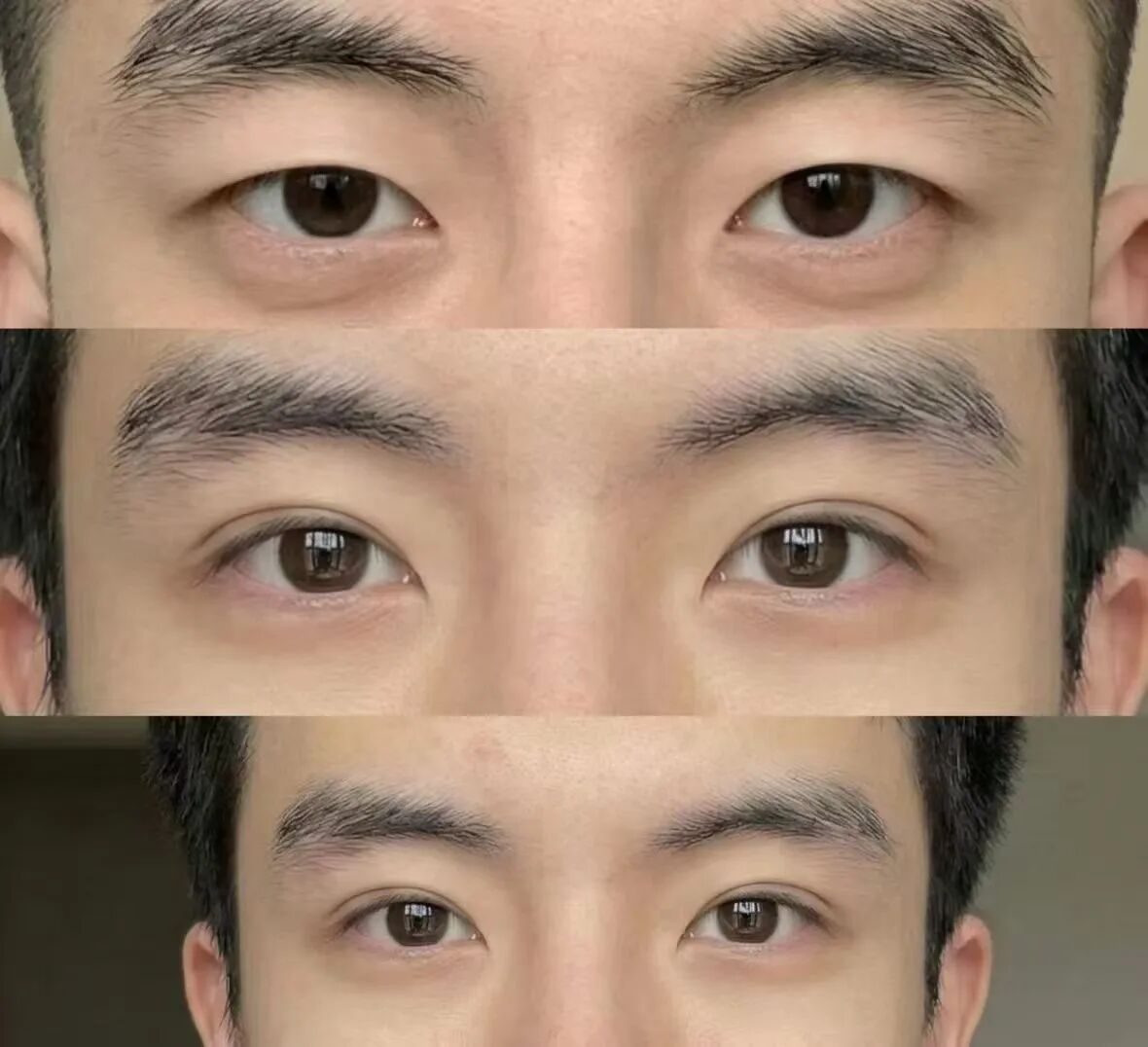 武汉男士双眼皮手术多少钱？武汉男士双眼皮手术有哪些并发症？