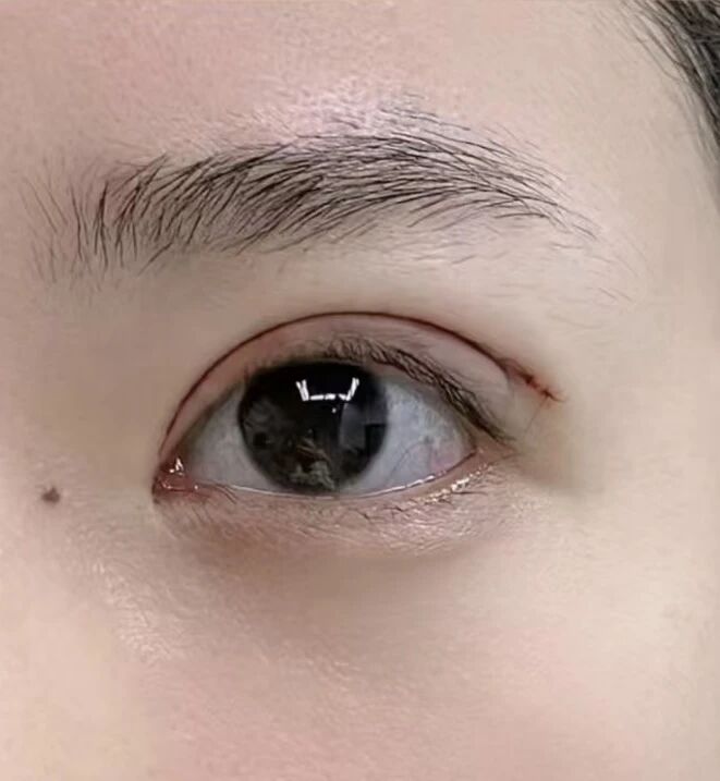 武汉埋线跟割双眼皮哪个好？武汉埋线跟割双眼皮哪个更划算？