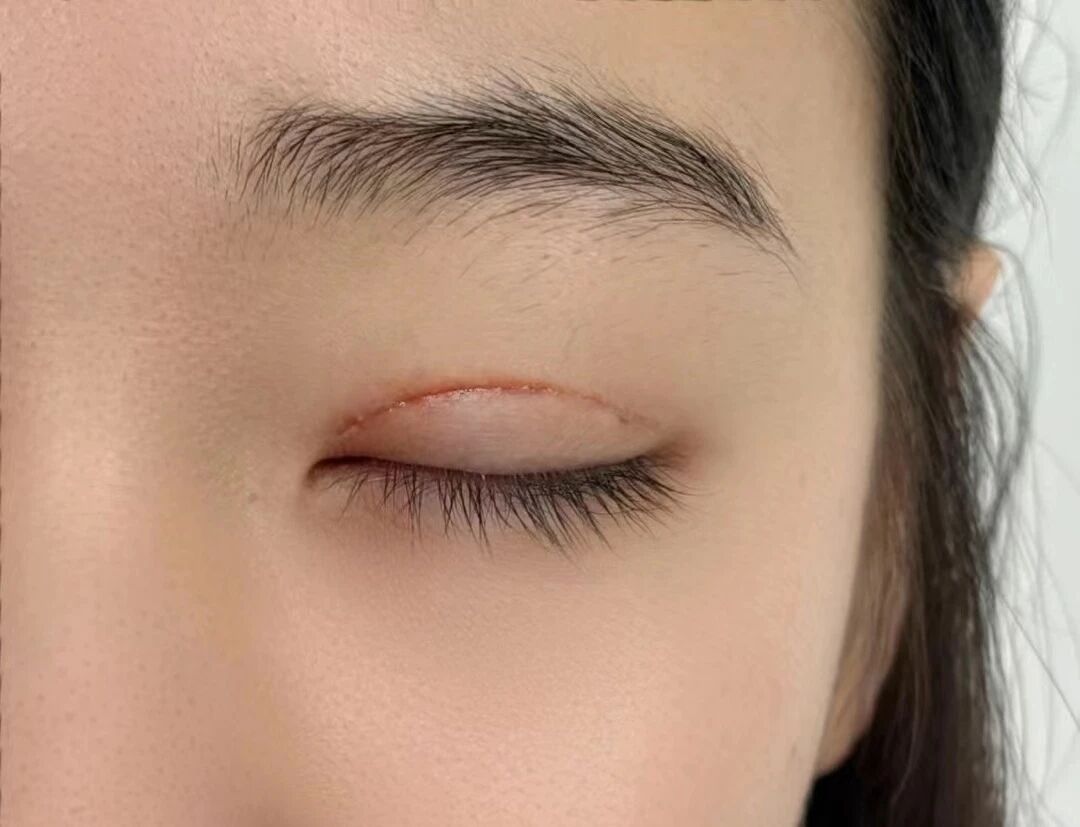 双眼皮手术的费用是多少？双眼皮手术的恢复时间是多久？