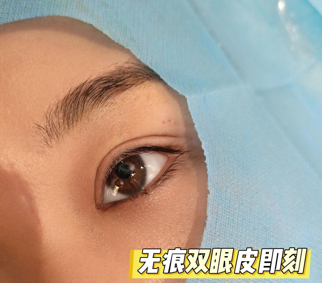 双眼皮做埋线好还是做切开好？埋线双眼皮和切开双眼皮哪个痕迹深？