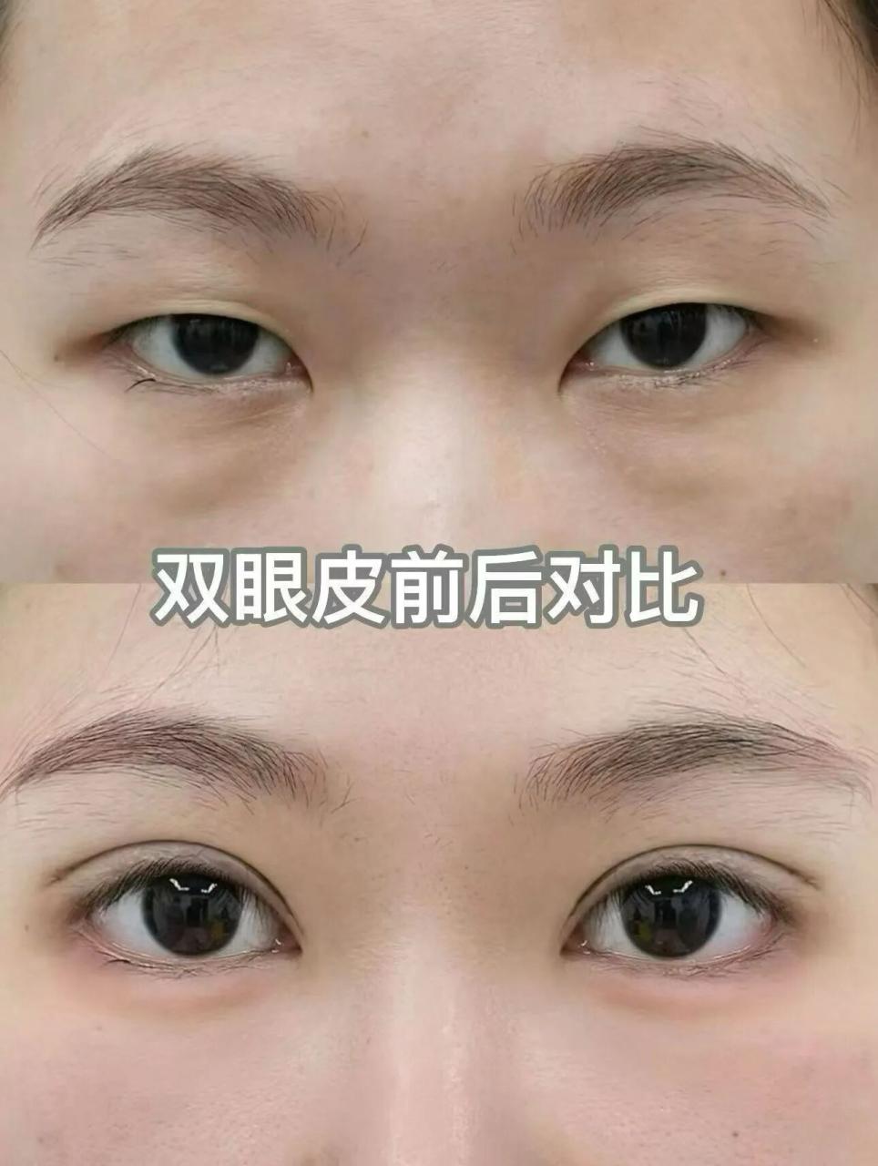 双眼皮手术大概多钱？做完双眼皮手术多久恢复自然？