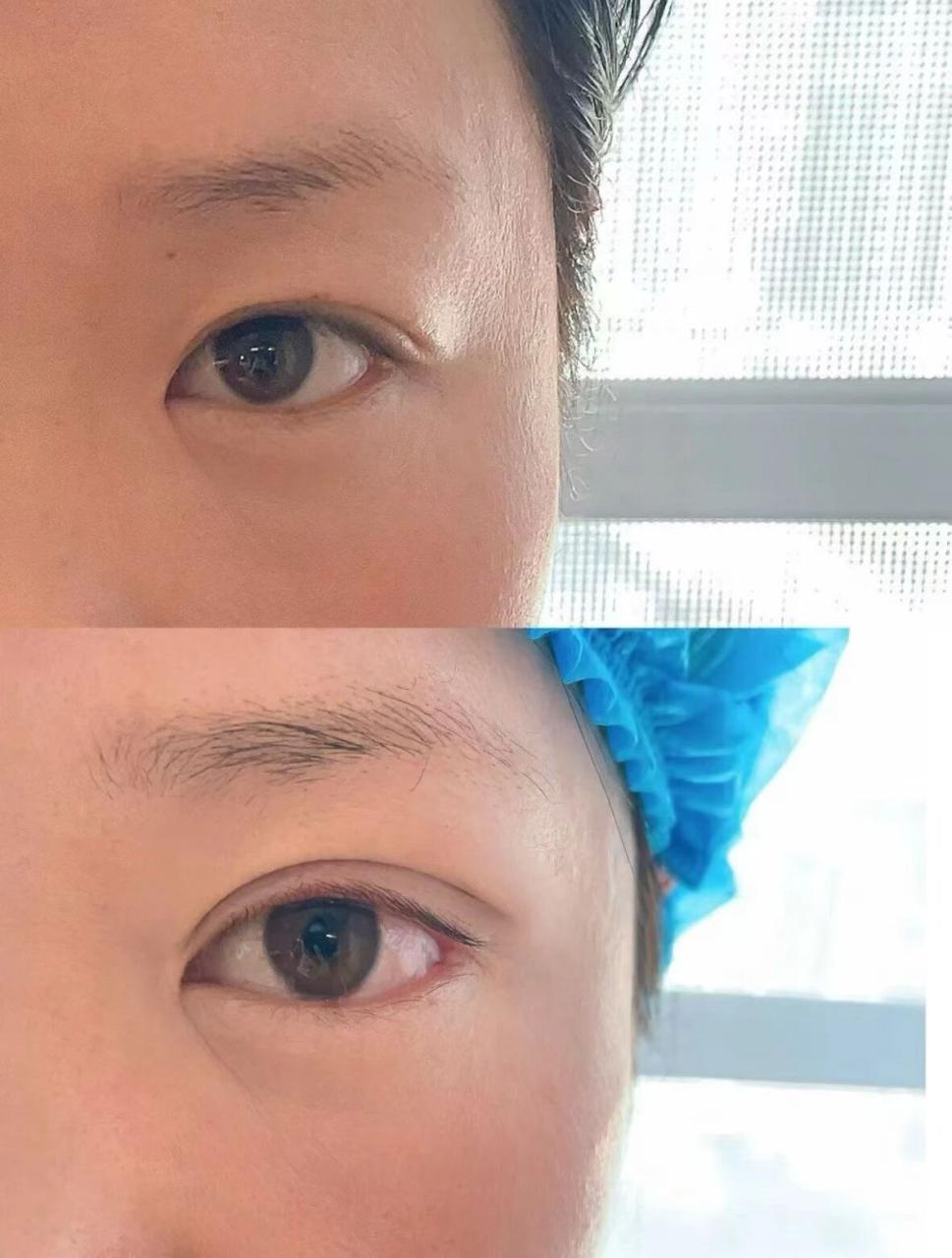 双眼皮埋线跟全切哪个好？双眼皮埋线跟全切分别是怎么做的？