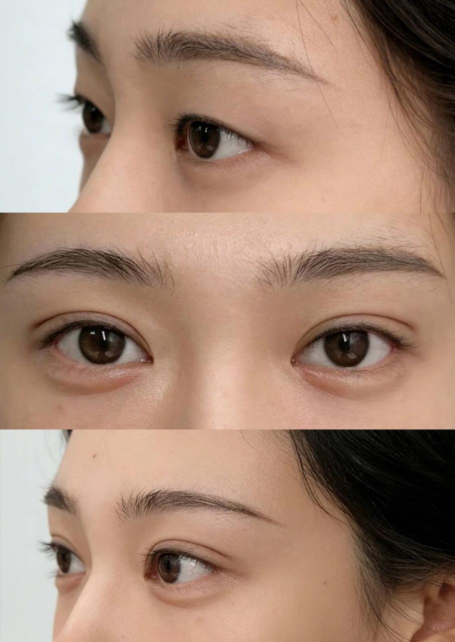 做完双眼皮多久恢复自然？做完双眼皮怎样恢复得快？