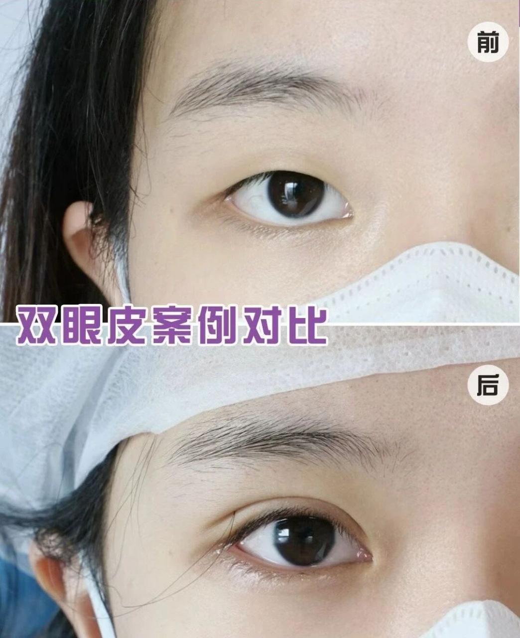 整容双眼皮费用是多少?双眼皮整形的方法有哪些?