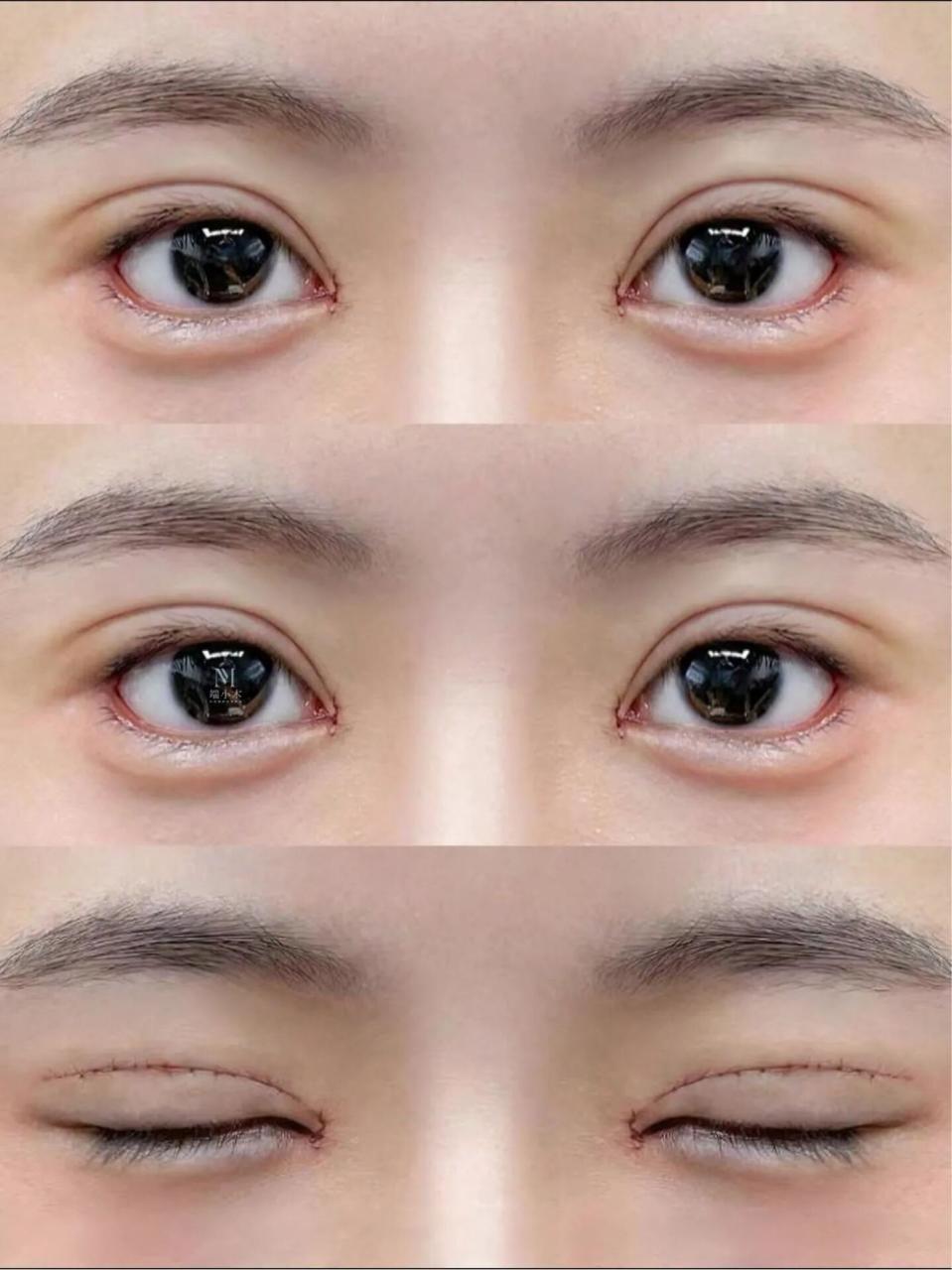 割双眼皮手术一般费用是多少？哪些人适合割双眼皮？