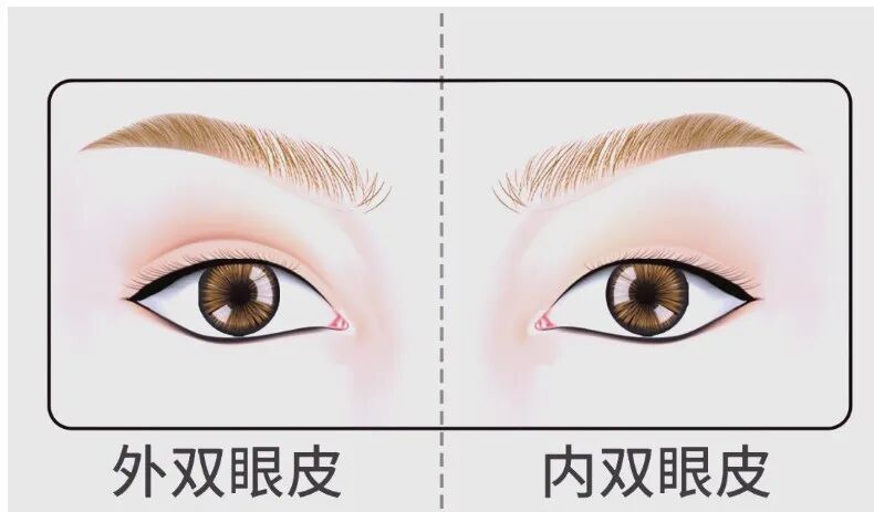 内双眼皮怎么变外双？怎么改变内双？