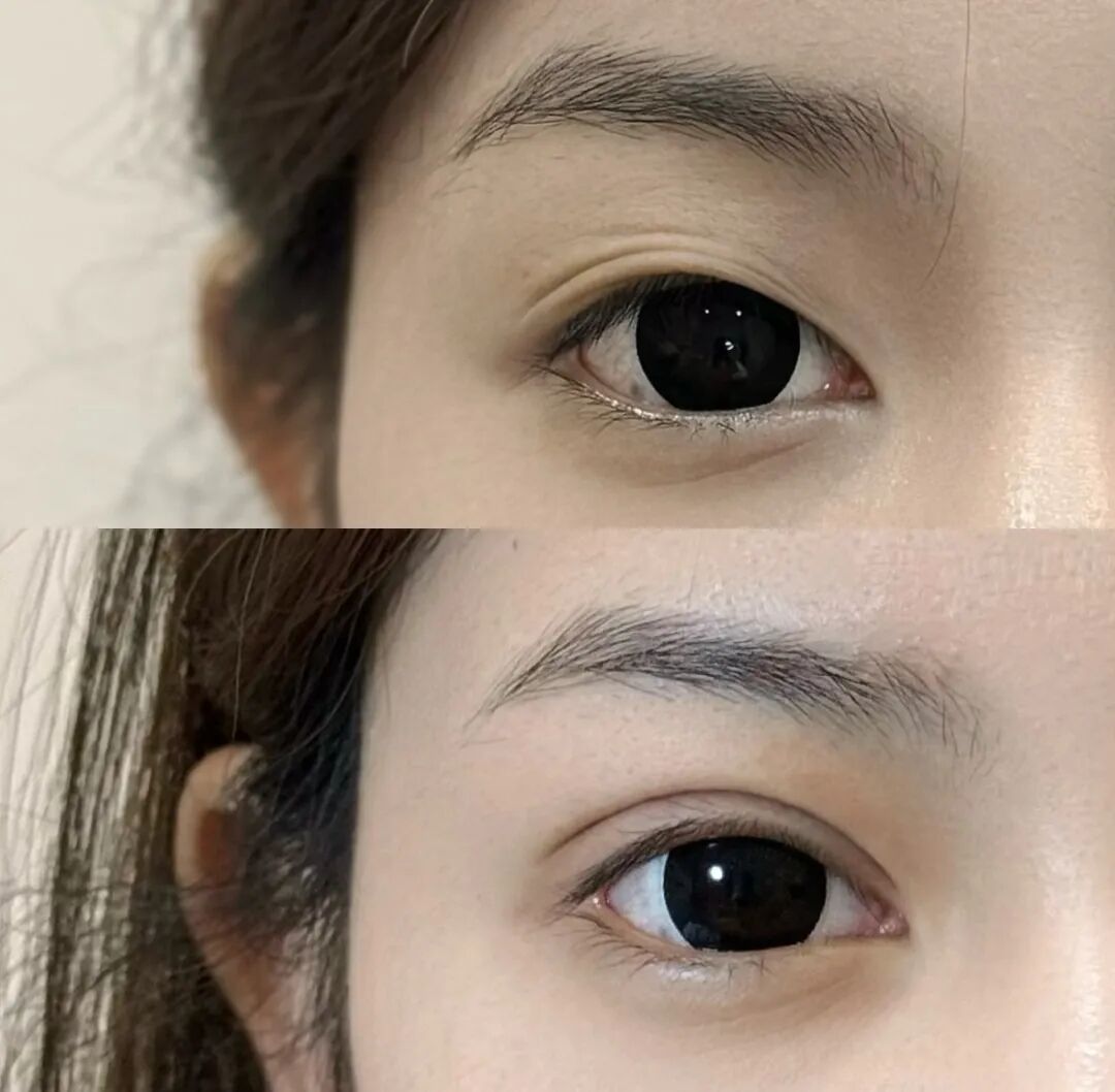 双眼皮手术后恢复期多长？双眼皮手术需要多久恢复？
