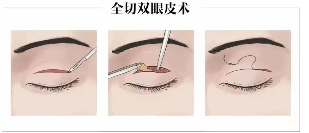 全切双眼皮多久消肿？全切双眼皮多久恢复？