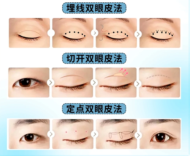双眼皮手术有哪几种？双眼皮手术要注意什么？