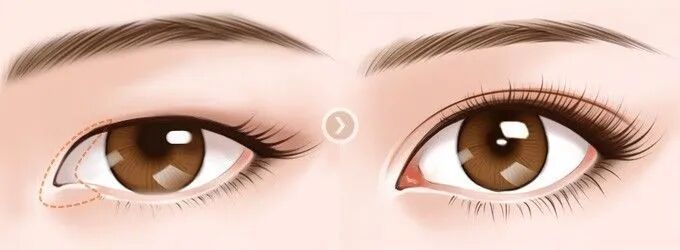 双隐形切开双眼皮多少钱?影响双隐形切开双眼皮价格的因素？