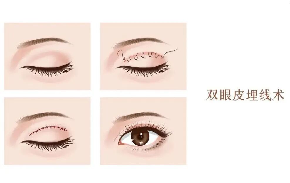 埋线双眼皮哪里做的好?埋线双眼皮的优势有哪些?