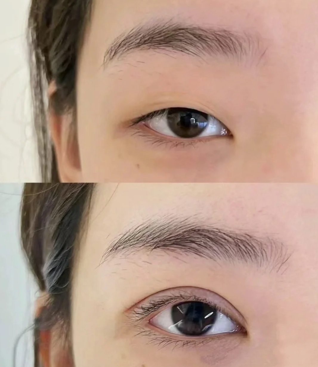 全切双眼皮好吗？全切双眼皮手术效果好不好？