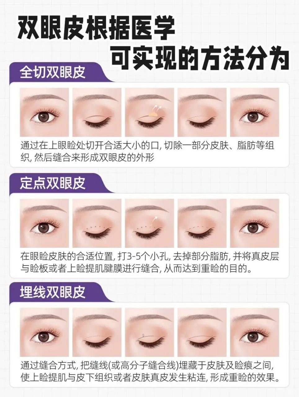 双眼皮术后如何快速消肿？双眼皮术后消肿的方法是什么？