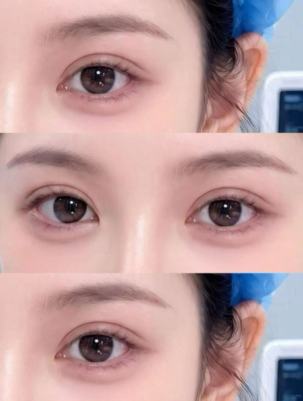 一般开双眼皮要多少钱？双眼皮手术很贵吗？