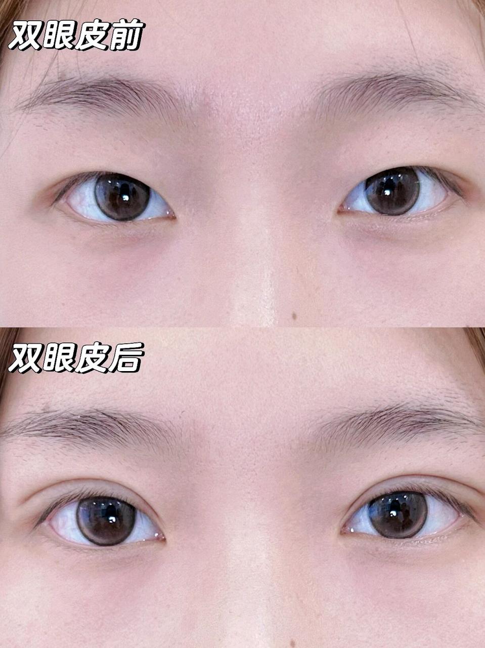 是单眼皮好还是双眼皮？双眼皮比单眼皮好看吗？