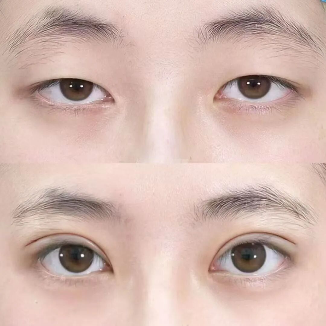 双眼皮手术几天拆线？双眼皮手术需要几天恢复？